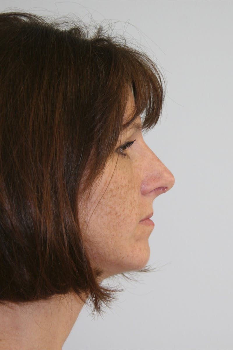 Chin Augmentation Before & After Gallery - Patient 143521909 - Image 4