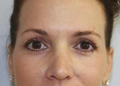 Eyelid Surgery Before & After Gallery - Patient 143521905 - Image 2