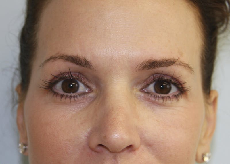 Eyelid Surgery Before & After Gallery - Patient 143521905 - Image 2