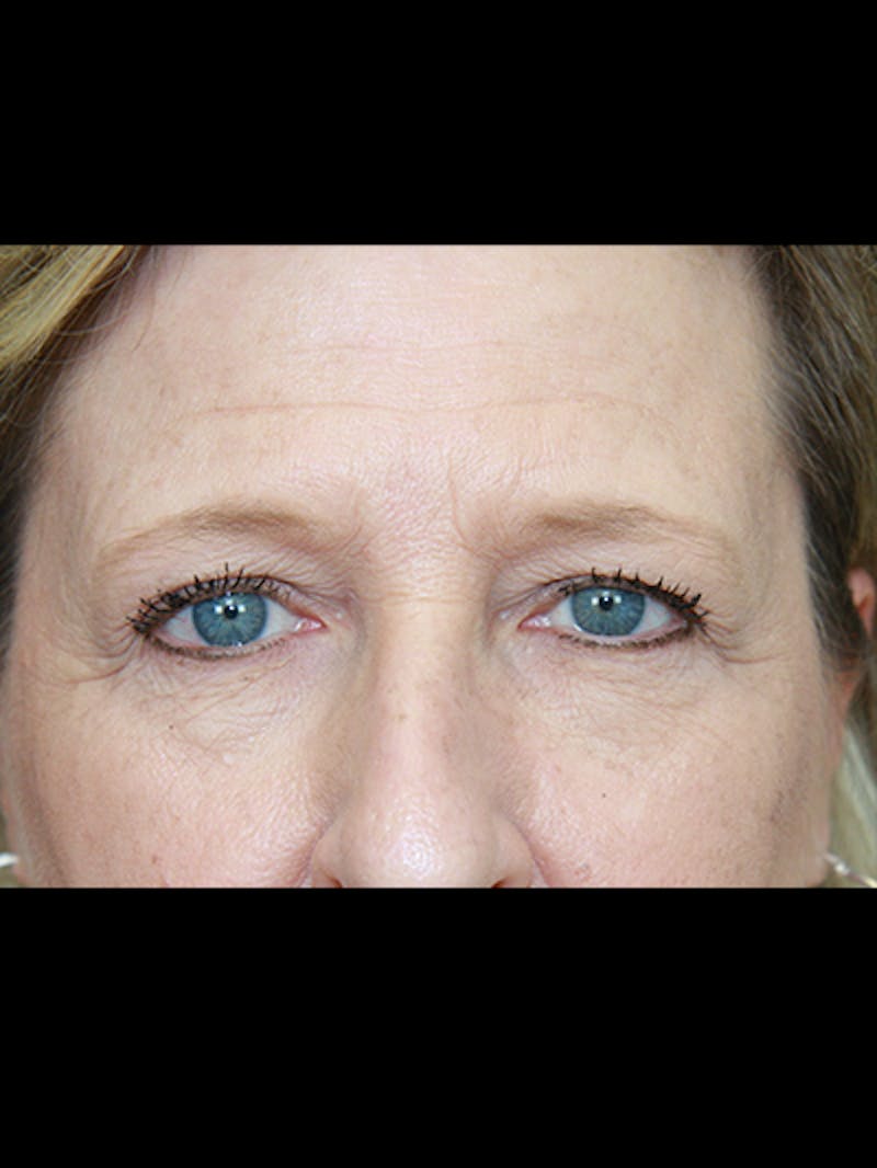 Brow Lift Before & After Gallery - Patient 143521902 - Image 5