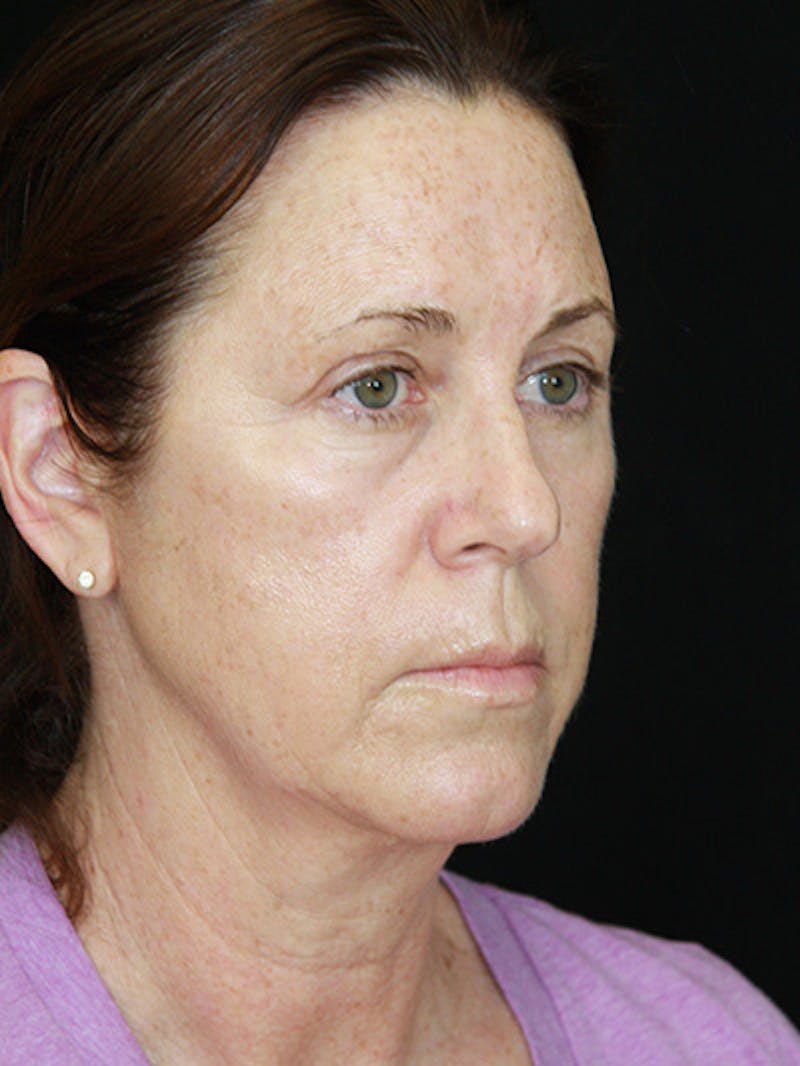 Facelift & Neck Lift Before & After Gallery - Patient 143521912 - Image 3