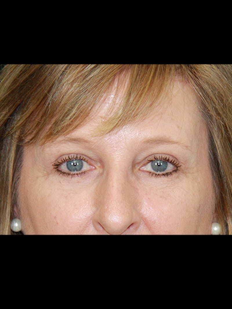 Brow Lift Before & After Gallery - Patient 143521902 - Image 6