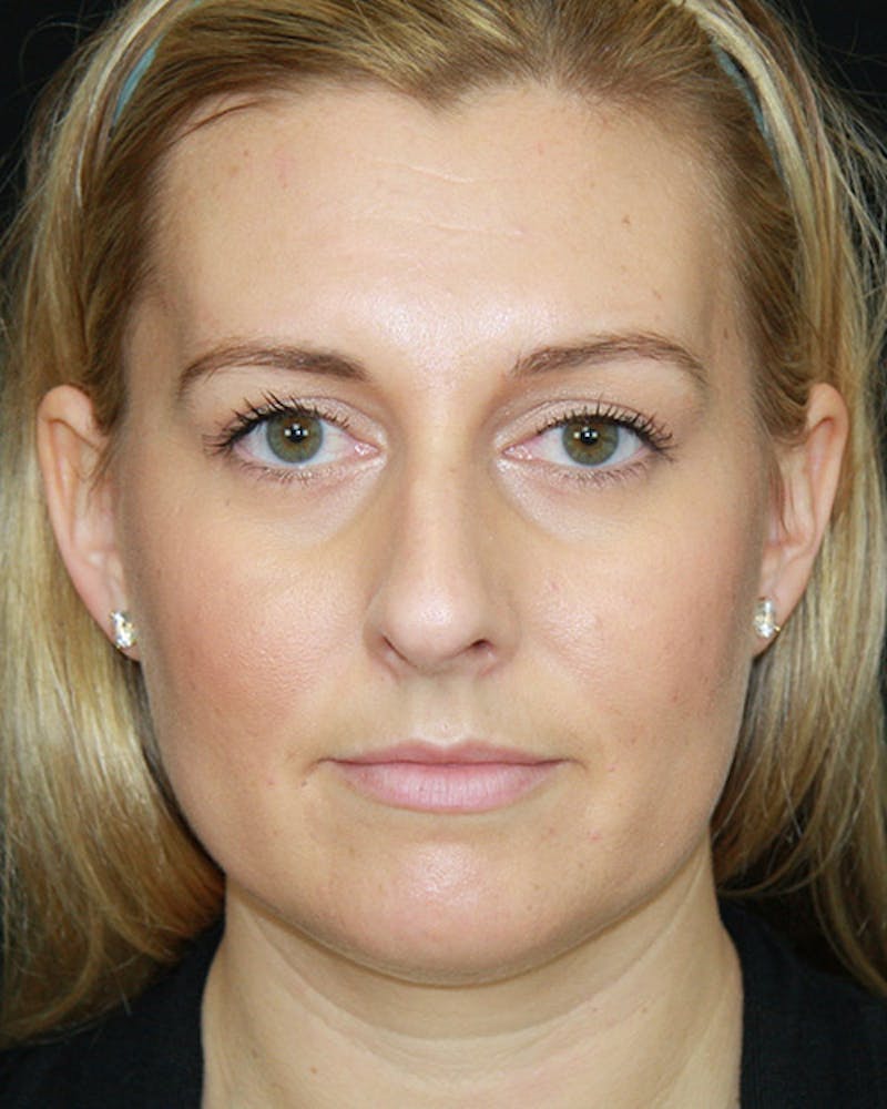 Rhinoplasty Before & After Gallery - Patient 143521916 - Image 1