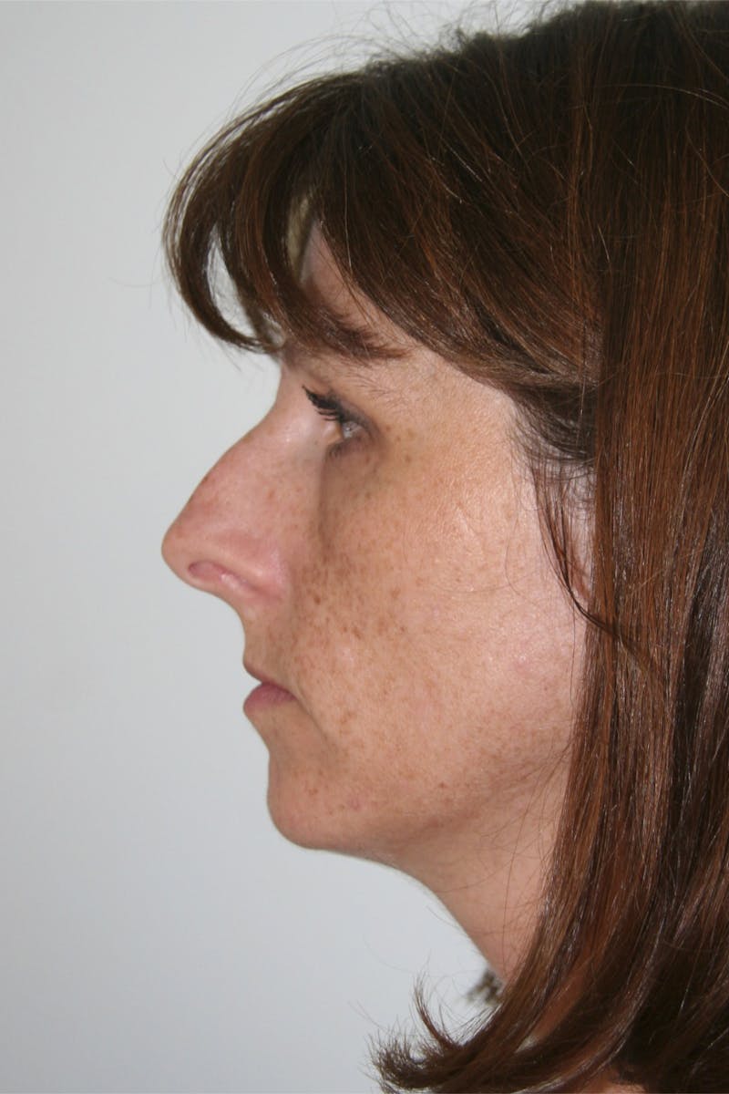 Chin Augmentation Before & After Gallery - Patient 143521909 - Image 5