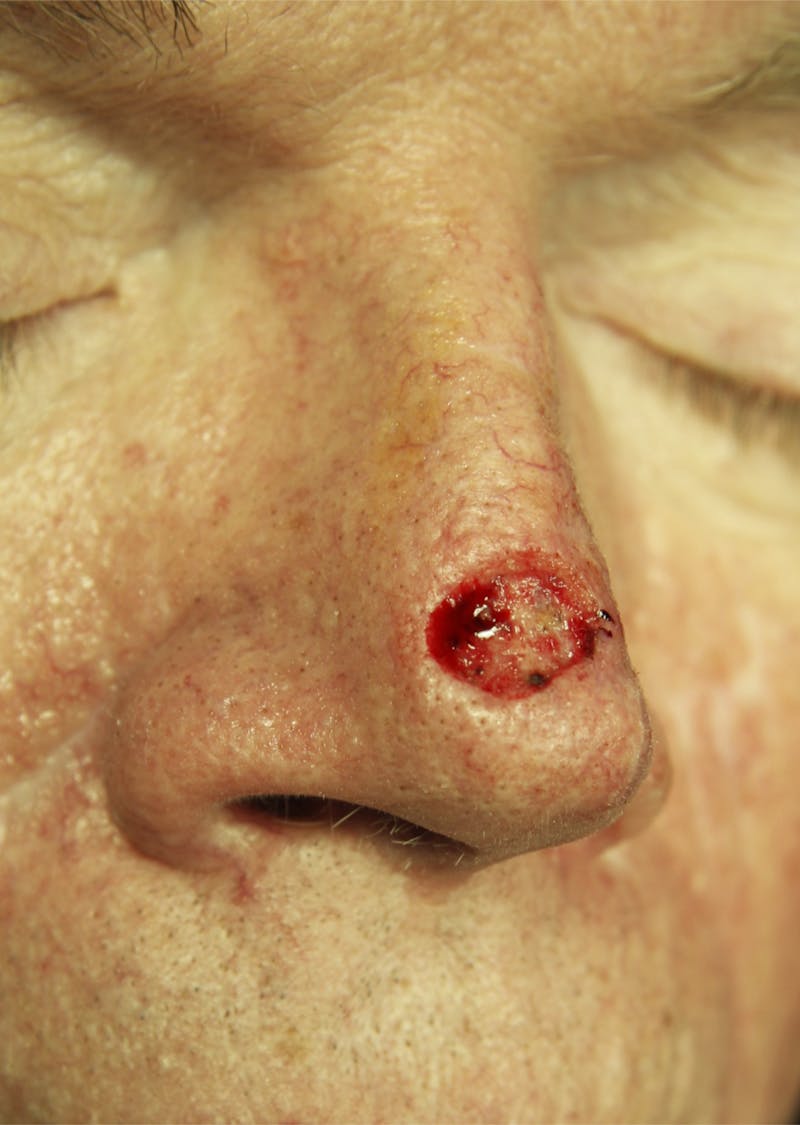 Mohs Reconstruction Before & After Gallery - Patient 143521908 - Image 1
