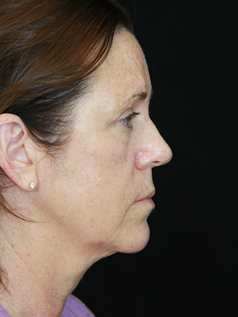 Facelift & Neck Lift Before & After Gallery - Patient 143521912 - Image 5