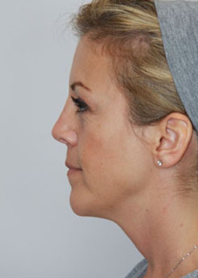 Fat Grafting Before & After Gallery - Patient 143521906 - Image 5