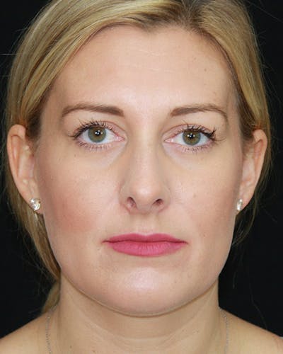 Rhinoplasty Before & After Gallery - Patient 143521916 - Image 2