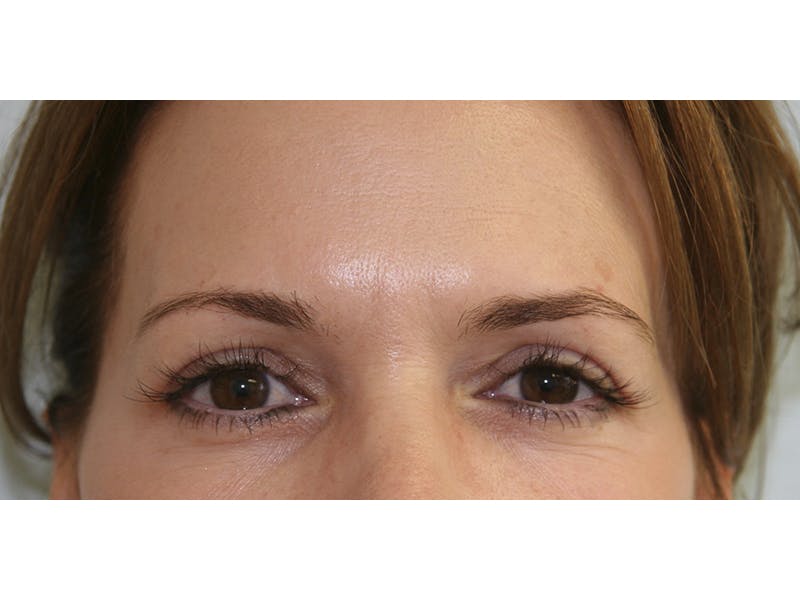 Eyelid Surgery Before & After Gallery - Patient 143521905 - Image 4