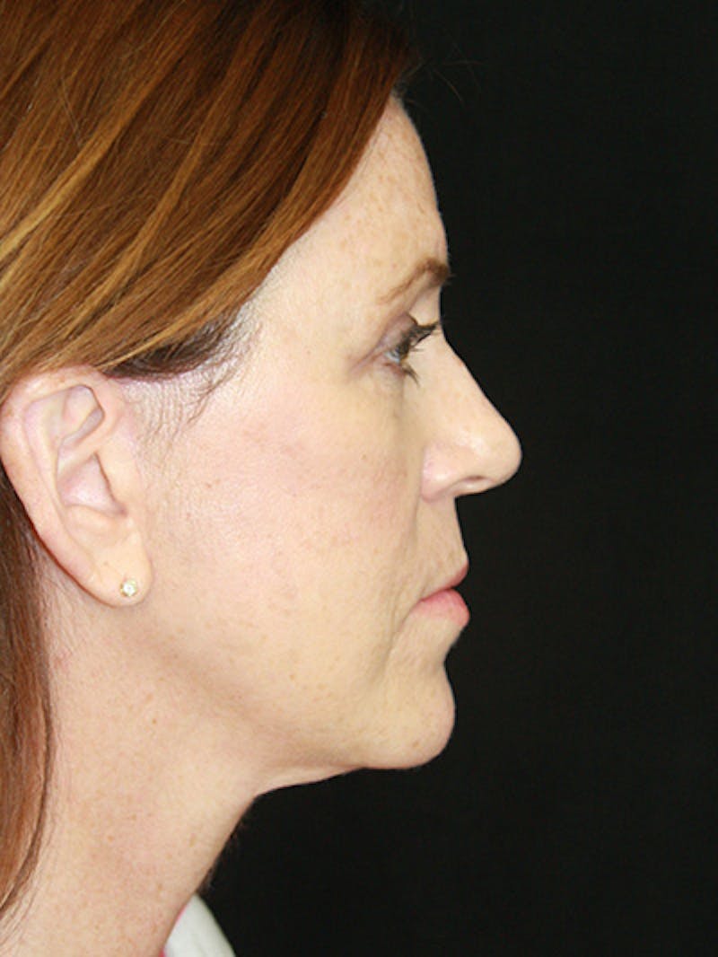 Facelift & Neck Lift Before & After Gallery - Patient 143521912 - Image 6