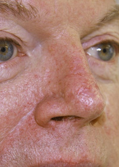 Mohs Reconstruction Before & After Gallery - Patient 143521908 - Image 2