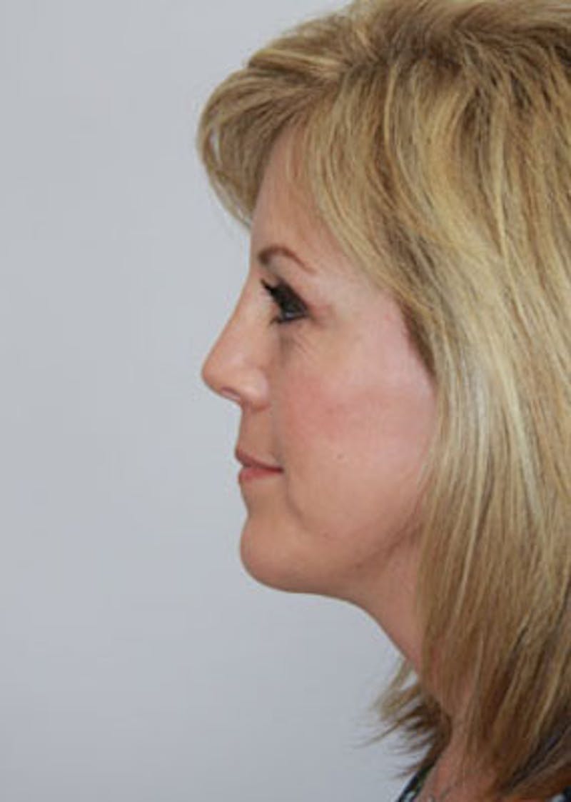 Fat Grafting Before & After Gallery - Patient 143521906 - Image 6