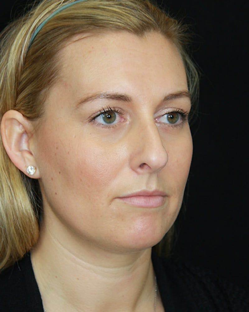 Rhinoplasty Before & After Gallery - Patient 143521916 - Image 3