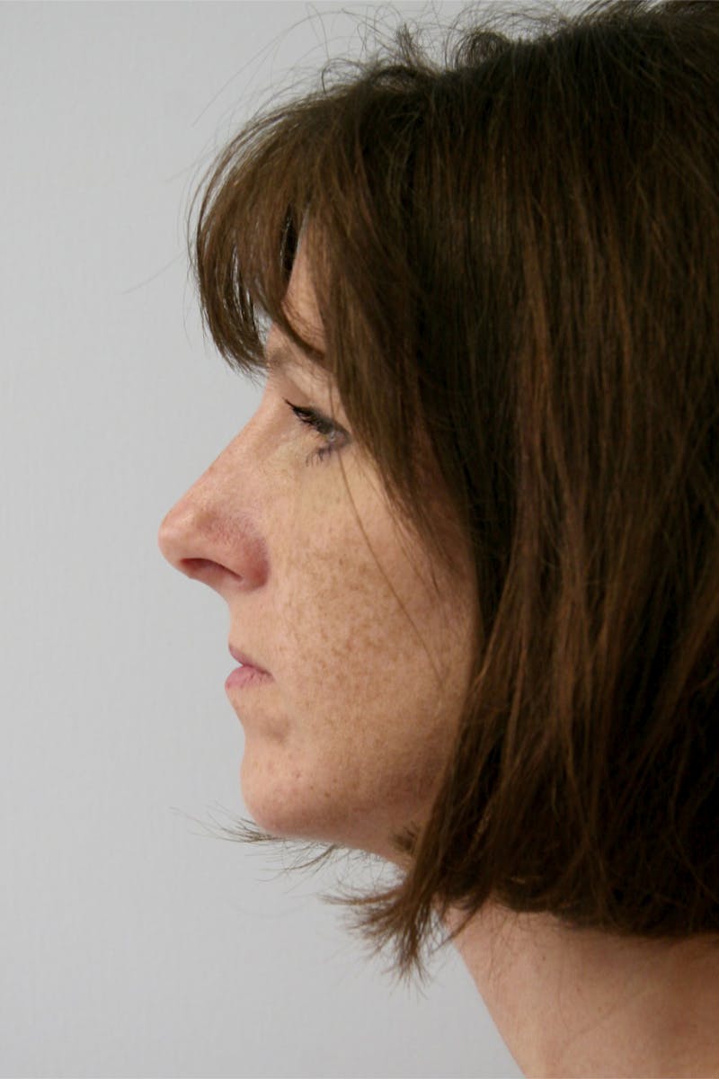 Chin Augmentation Before & After Gallery - Patient 143521909 - Image 6