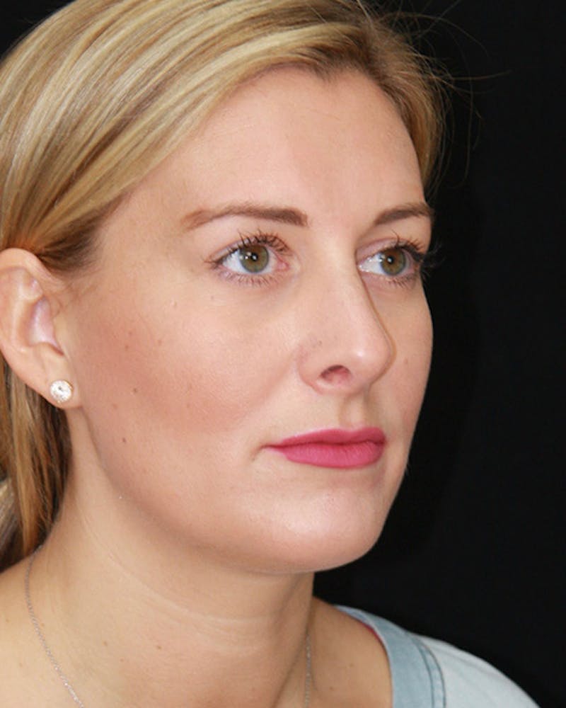Rhinoplasty Before & After Gallery - Patient 143521916 - Image 4