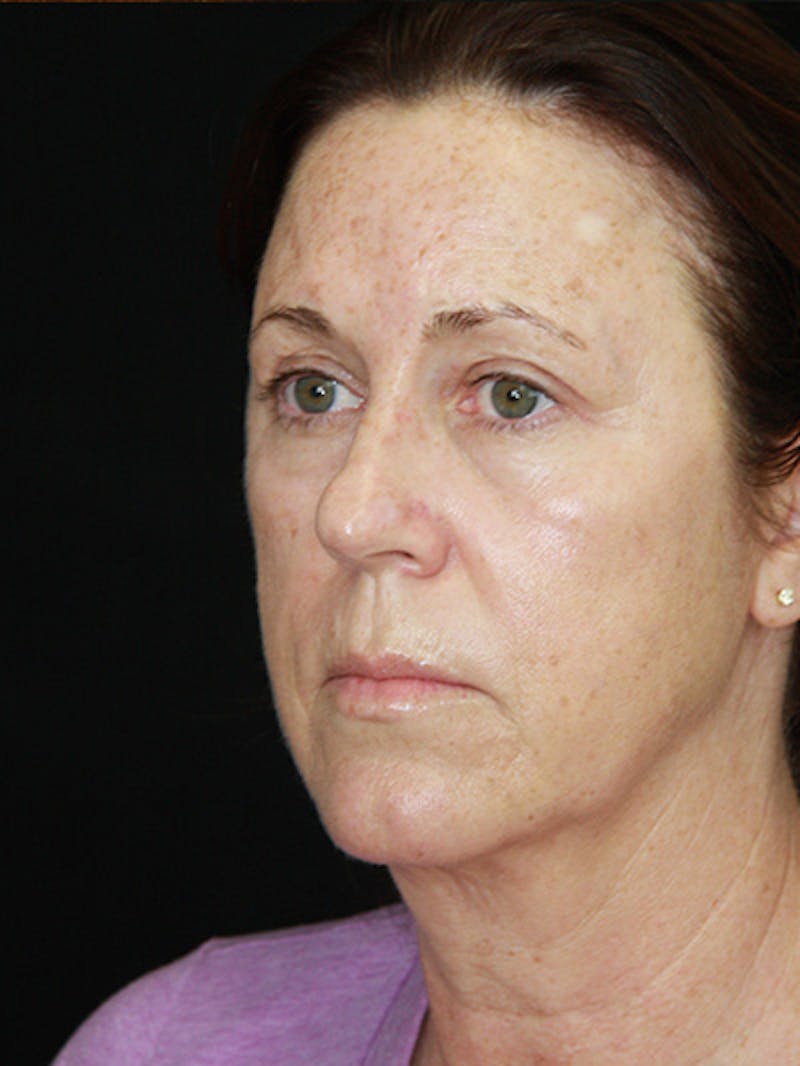 Facelift & Neck Lift Before & After Gallery - Patient 143521912 - Image 7