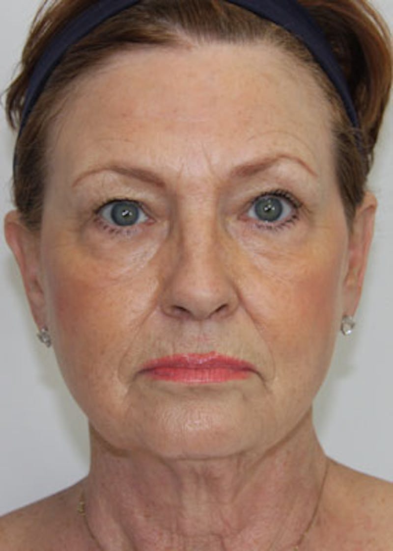 Fat Grafting Before & After Gallery - Patient 143521914 - Image 1