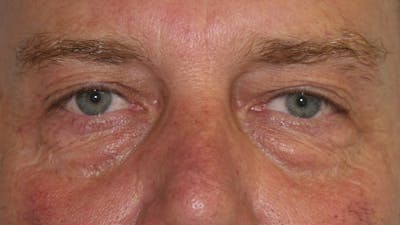 Eyelid Surgery Before & After Gallery - Patient 143521911 - Image 1