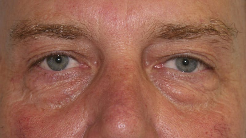 Eyelid Surgery Before & After Gallery - Patient 143521911 - Image 1