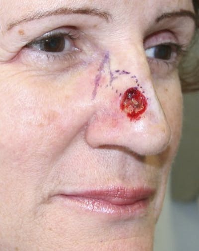 Mohs Reconstruction Before & After Gallery - Patient 143521910 - Image 1