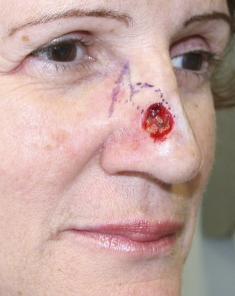 Mohs Reconstruction Before & After Gallery - Patient 143521910 - Image 1