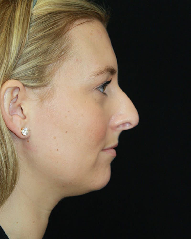 Rhinoplasty Before & After Gallery - Patient 143521916 - Image 5