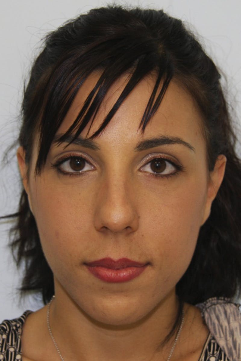Chin Augmentation Before & After Gallery - Patient 143521924 - Image 1