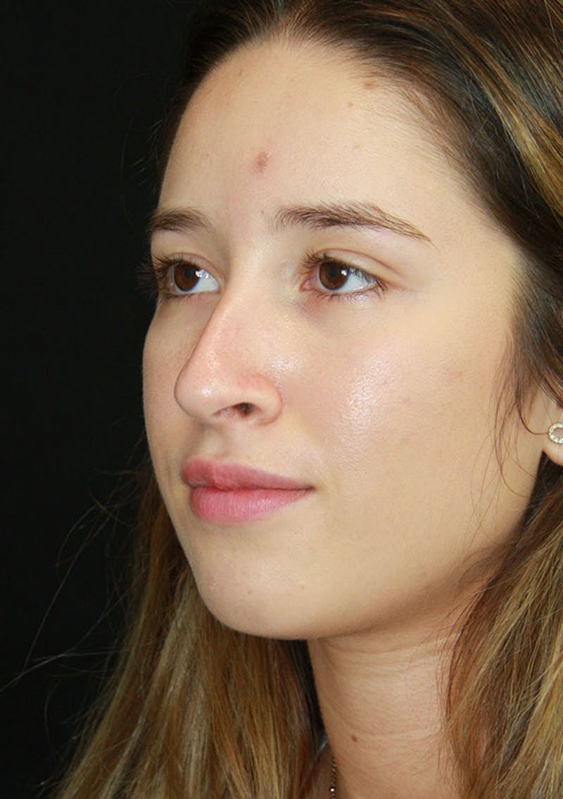 Non-Surgical Rhinoplasty Before & After Gallery - Patient 143521913 - Image 1