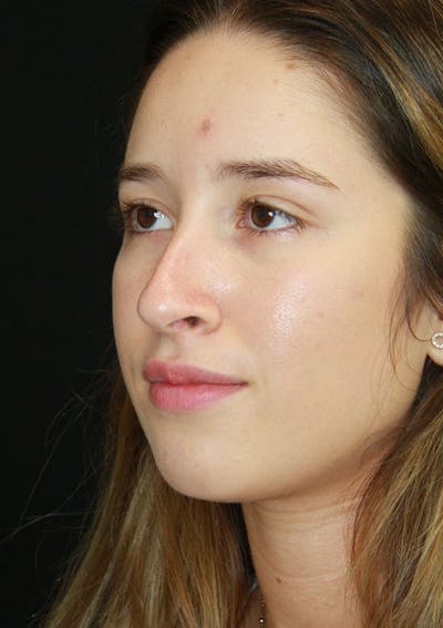 Non-Surgical Rhinoplasty Before & After Gallery - Patient 143521913 - Image 1