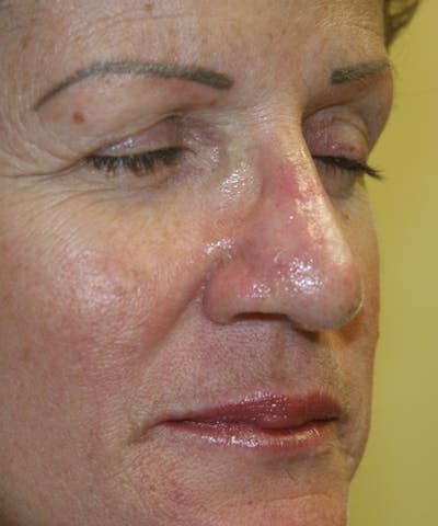 Mohs Reconstruction Before & After Gallery - Patient 143521910 - Image 2