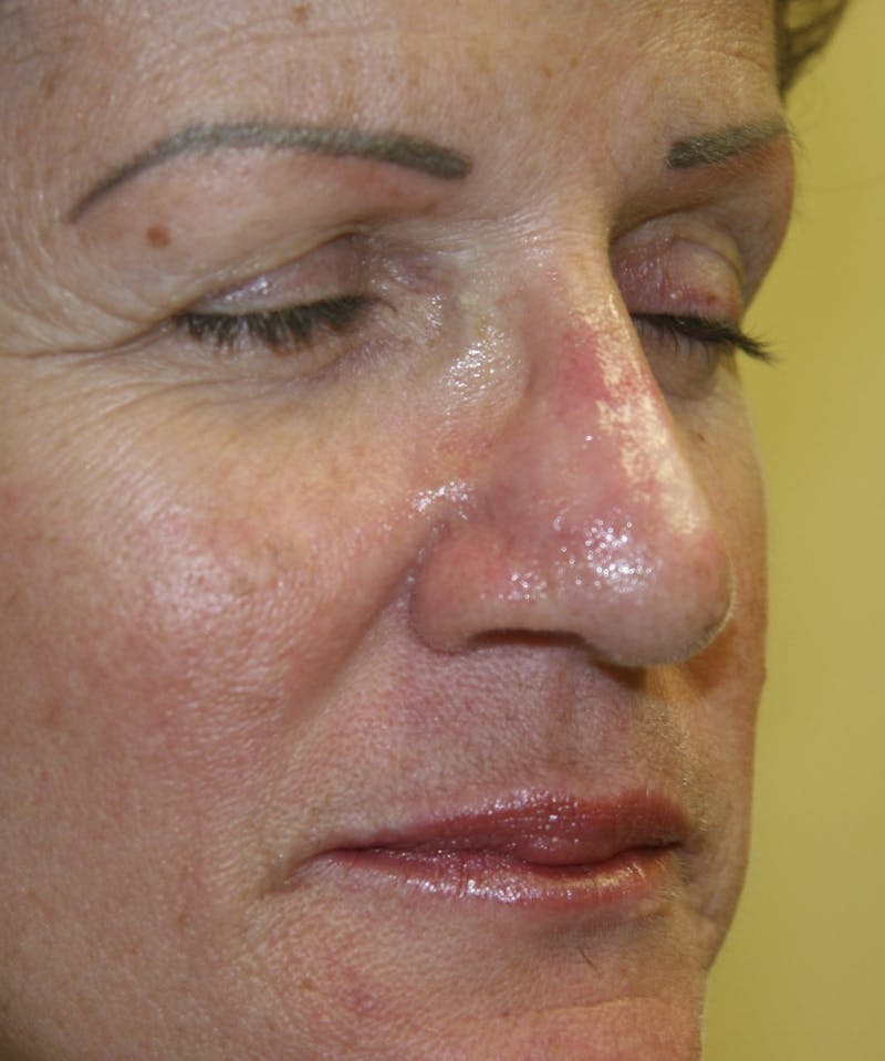 Mohs Reconstruction Before & After Gallery - Patient 143521910 - Image 2