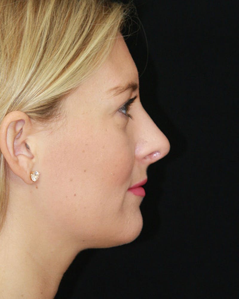 Rhinoplasty Before & After Gallery - Patient 143521916 - Image 6