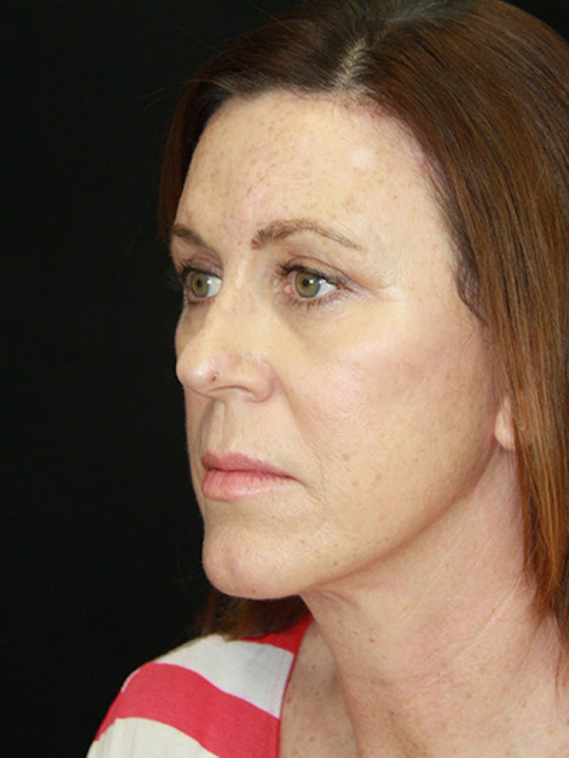 Facelift & Neck Lift Before & After Gallery - Patient 143521912 - Image 8