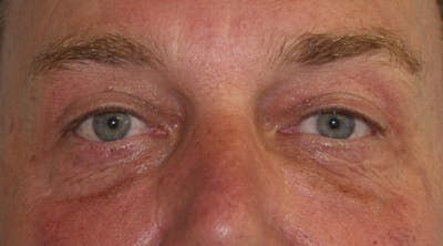 Eyelid Surgery Before & After Gallery - Patient 143521911 - Image 2