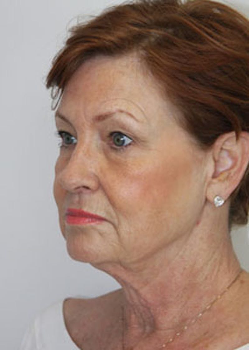 Fat Grafting Before & After Gallery - Patient 143521914 - Image 3