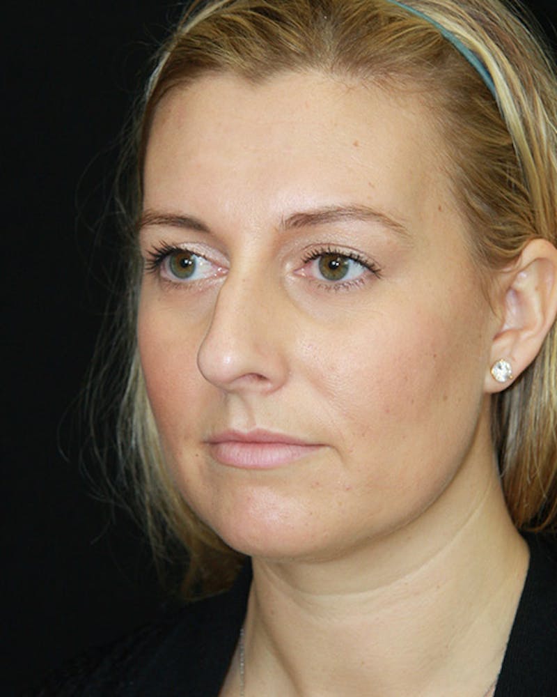 Rhinoplasty Before & After Gallery - Patient 143521916 - Image 7