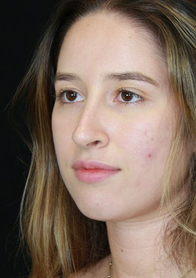 Non-Surgical Rhinoplasty Before & After Gallery - Patient 143521913 - Image 2