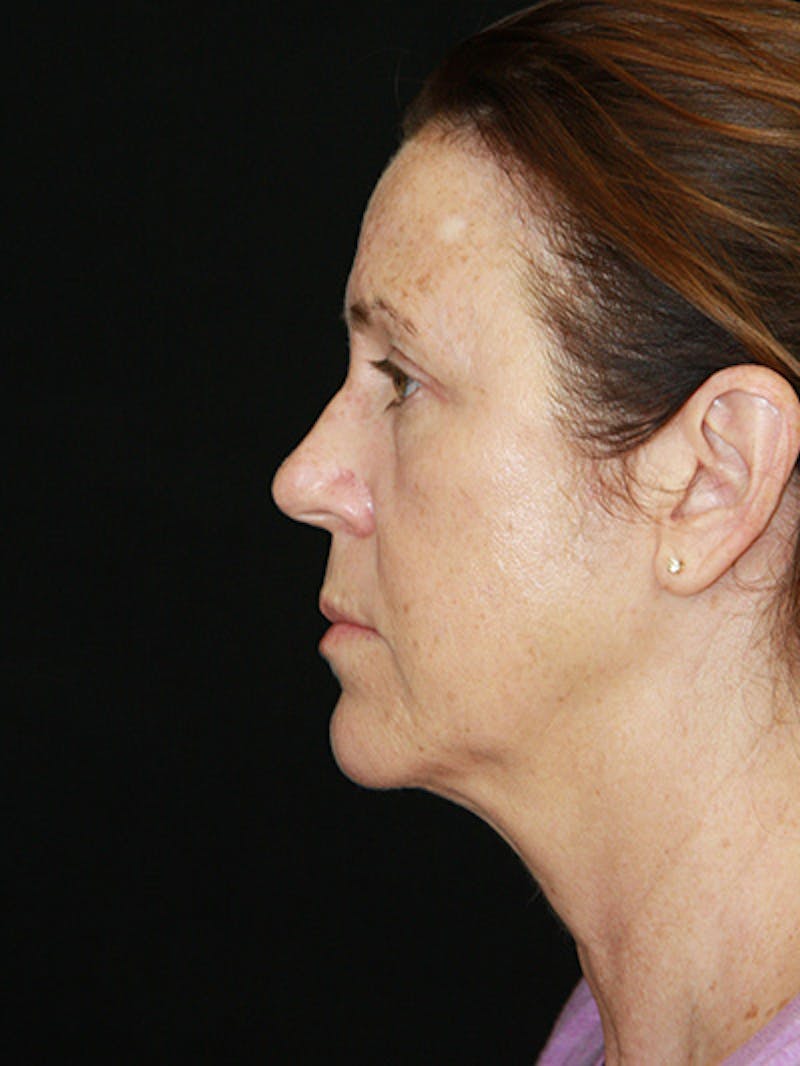 Facelift & Neck Lift Before & After Gallery - Patient 143521912 - Image 9