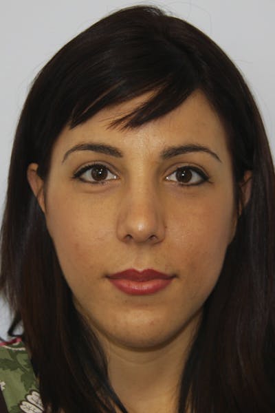 Chin Augmentation Before & After Gallery - Patient 143521924 - Image 2