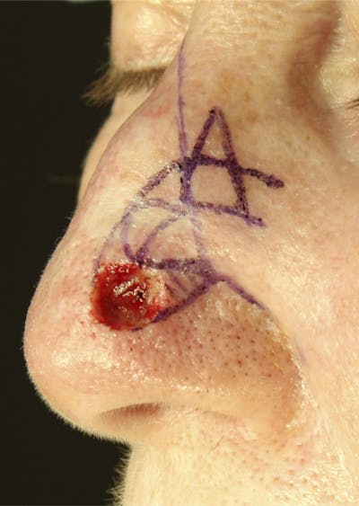 Mohs Reconstruction Before & After Gallery - Patient 143521915 - Image 1