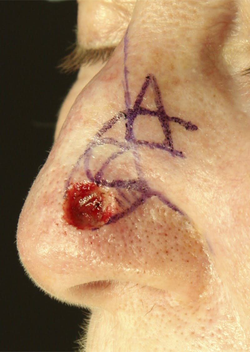 Mohs Reconstruction Before & After Gallery - Patient 143521915 - Image 1