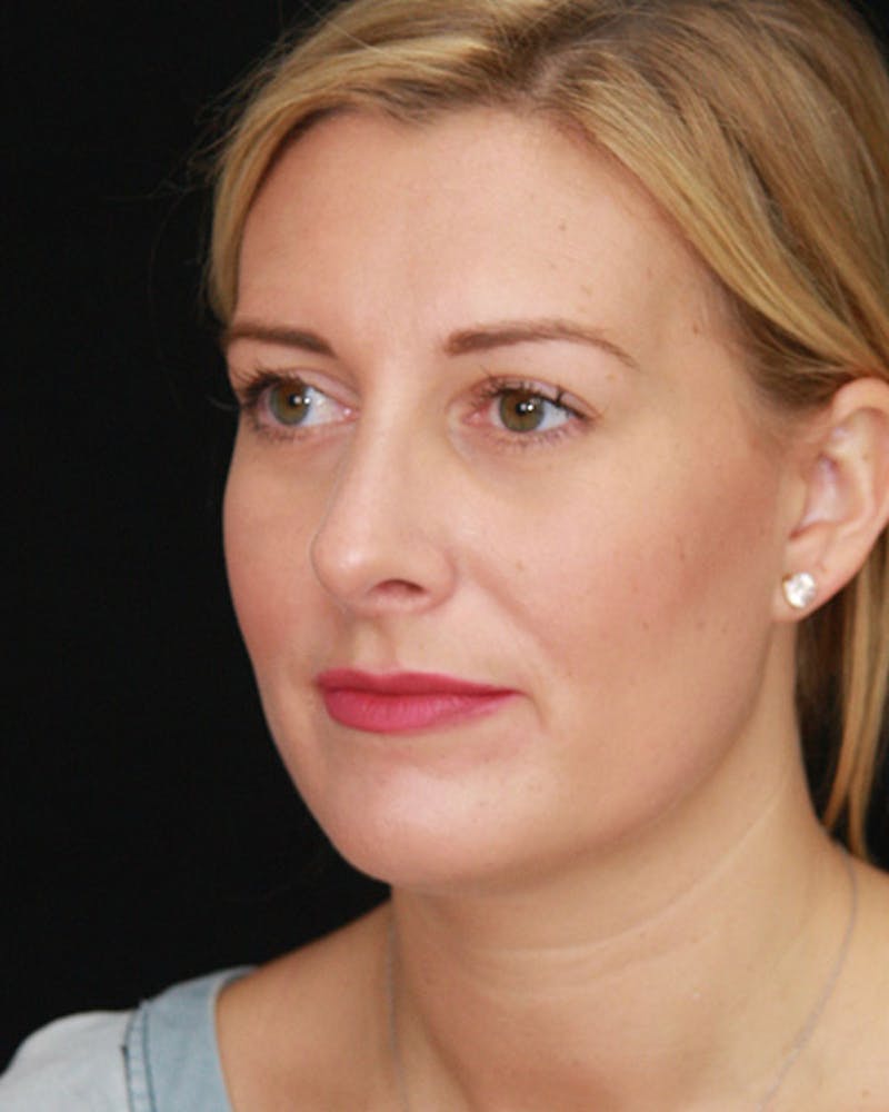 Rhinoplasty Before & After Gallery - Patient 143521916 - Image 8