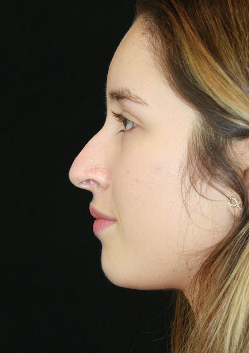 Non-Surgical Rhinoplasty Before & After Gallery - Patient 143521913 - Image 3