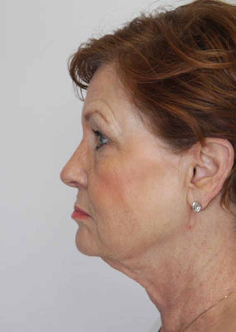 Fat Grafting Before & After Gallery - Patient 143521914 - Image 5