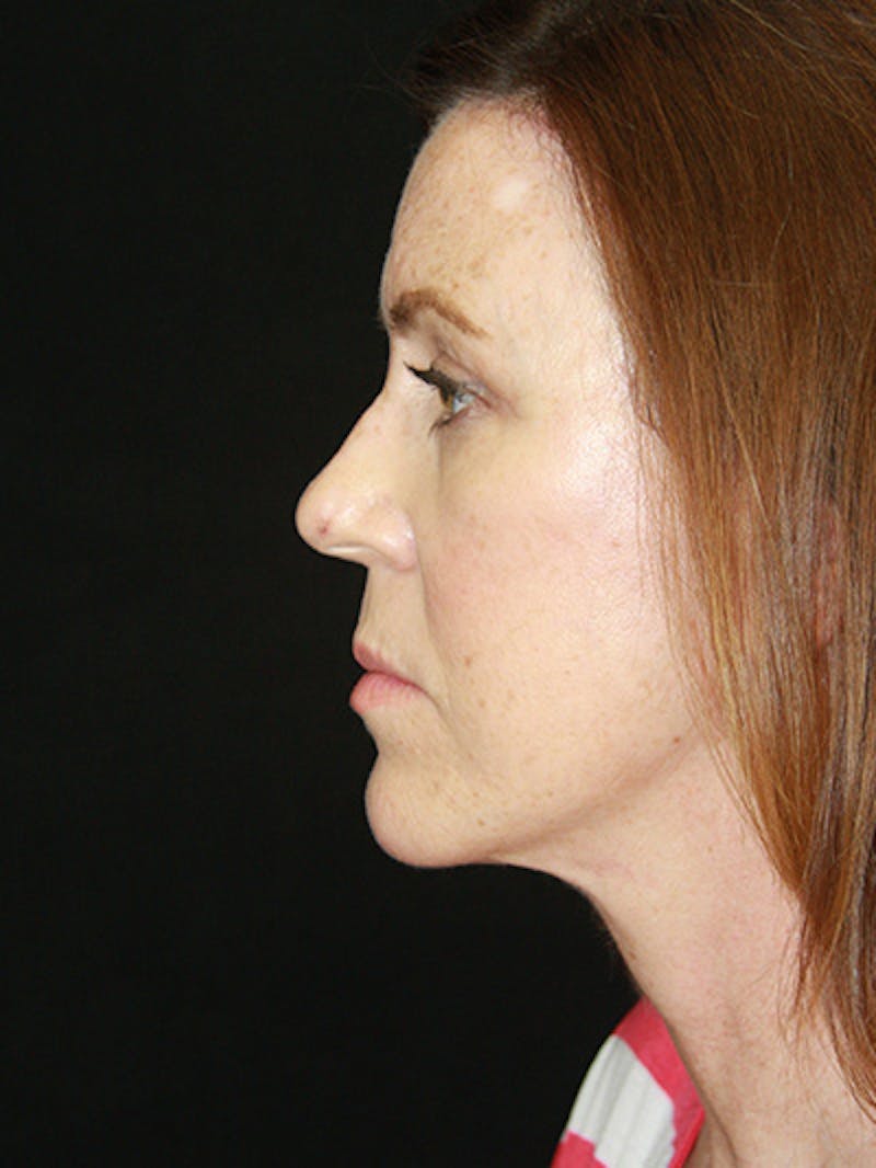 Facelift & Neck Lift Before & After Gallery - Patient 143521912 - Image 10