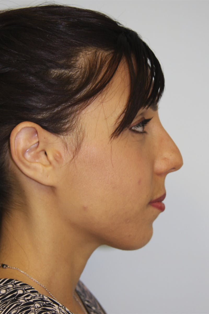 Chin Augmentation Before & After Gallery - Patient 143521924 - Image 3