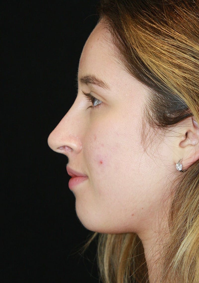 Non-Surgical Rhinoplasty Before & After Gallery - Patient 143521913 - Image 4