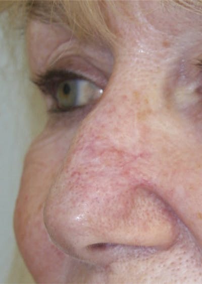Mohs Reconstruction Before & After Gallery - Patient 143521915 - Image 2