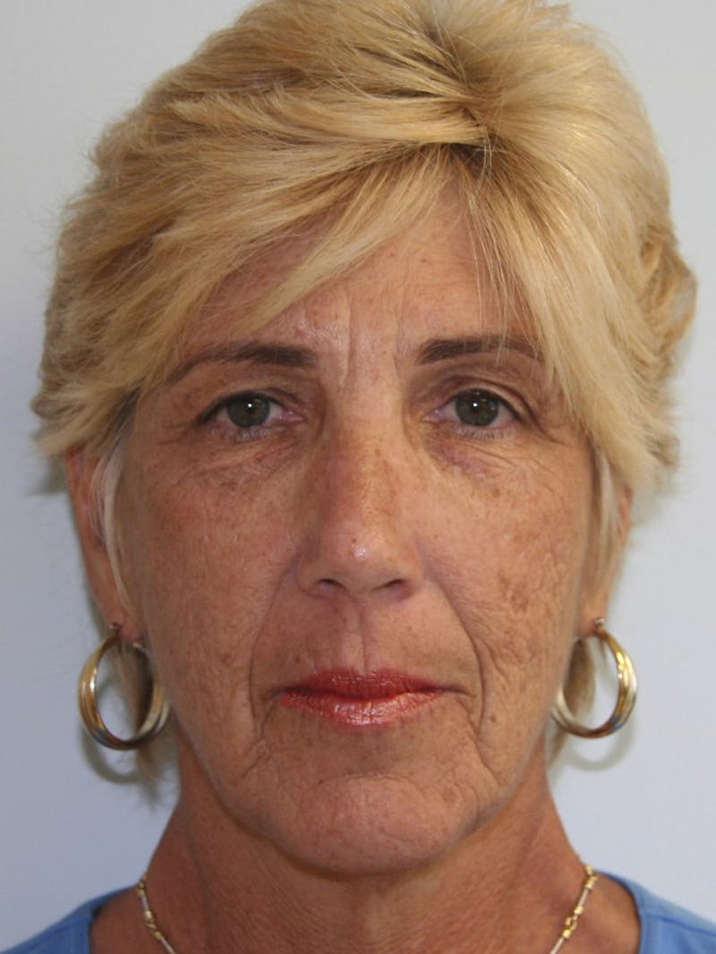 Eyelid Surgery Before & After Gallery - Patient 143521921 - Image 1