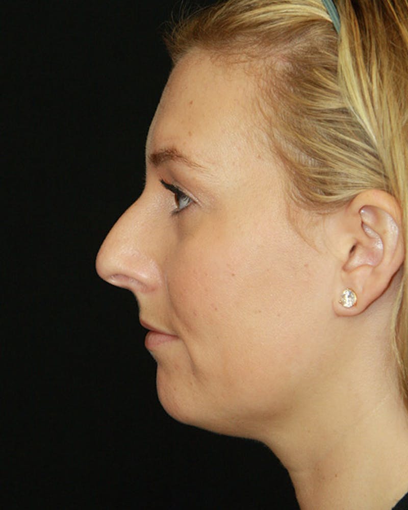 Rhinoplasty Before & After Gallery - Patient 143521916 - Image 9